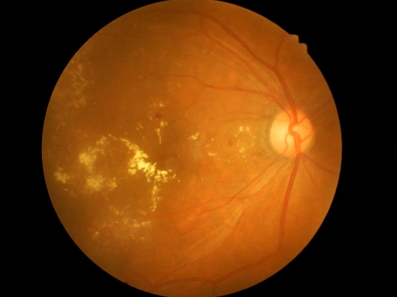Преимущества лечения атрофии зрительного нерва Стволовыми клетками